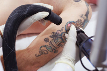 Laser Tattoo Reduction