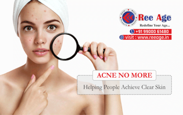 Acne No More