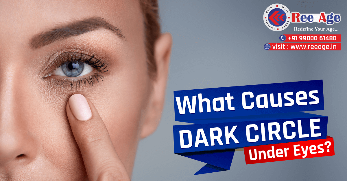 Causes of under eye dark circle