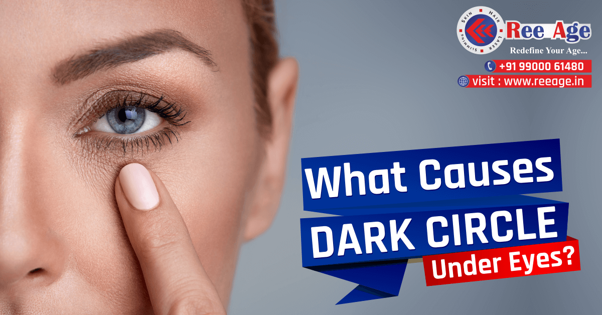 Dark circles under the eyes: Causes, treatment options, and more